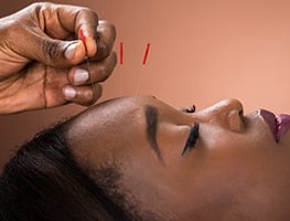 Woman undergoing acupuncture for fertility